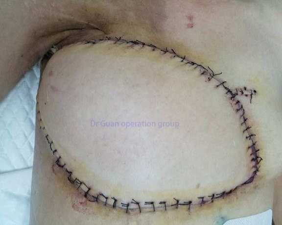 乳腺癌根治术后放射性溃疡的治疗体会