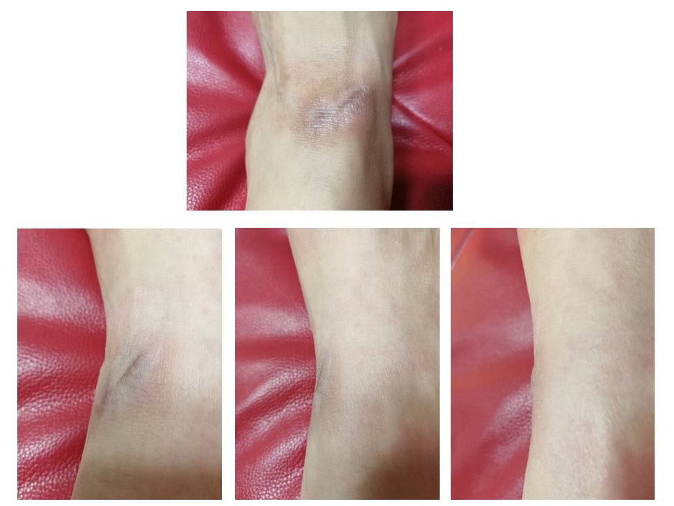 瘢痕(疤痕)增生的治疗方法