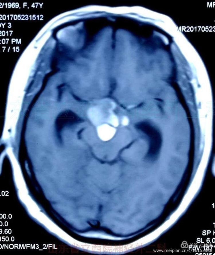 全切巨大钙化颅咽管瘤