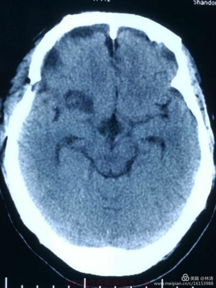全切巨大钙化颅咽管瘤
