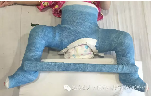 儿童发育性髋关节脱位