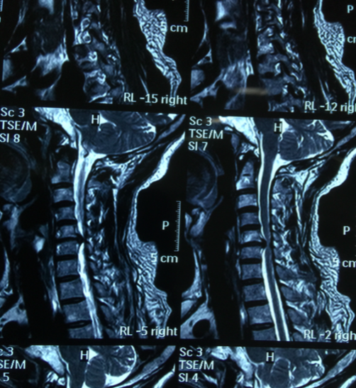 颈椎病新疗法 Keyhole手术 颈椎椎间孔镜 颈椎病新疗法 Keyhole手术 颈椎椎间孔镜