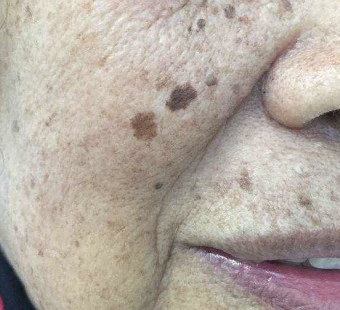 脂溢性角化病 www.haodf.com