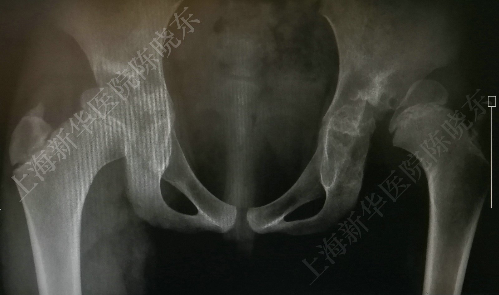 髖關節高脫位關節囊成形術colonna手術視頻