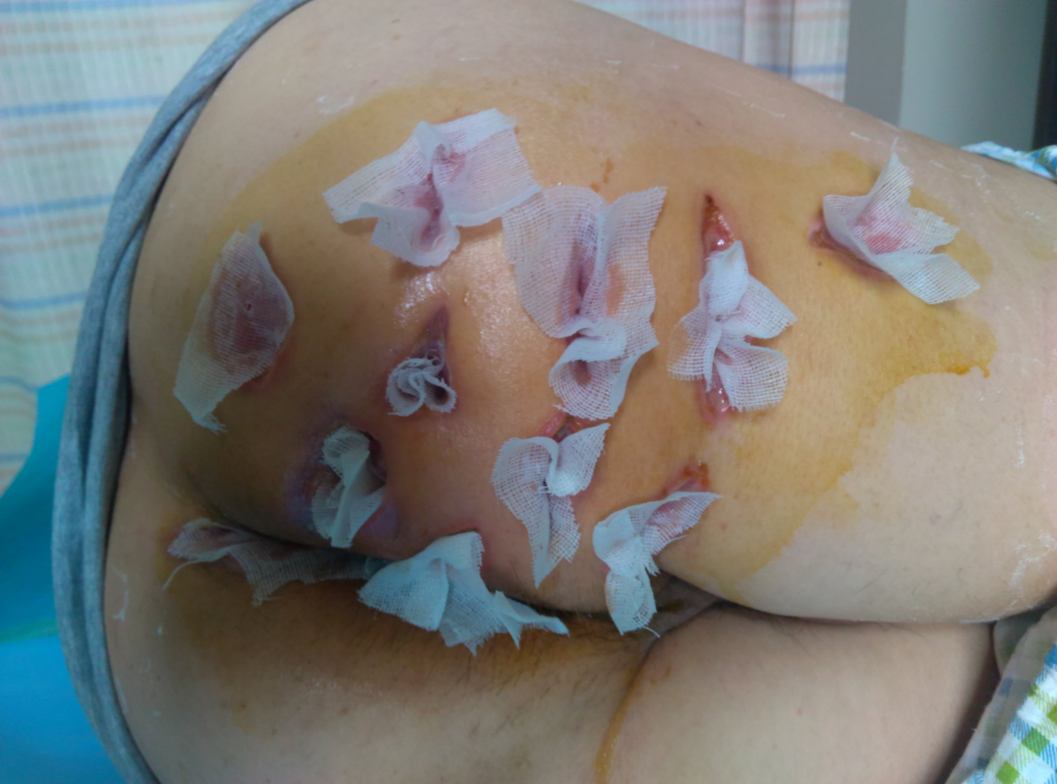 肛裂术后20天伤口图片图片
