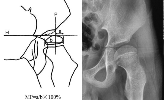 脑瘫患儿继发性髋关节发育异常的x线检测 - 好大夫在线