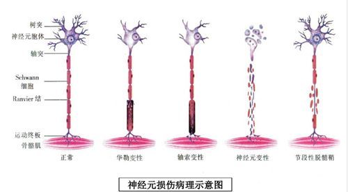 華勒變性指神經纖維受各種外傷斷裂後,遠端神經纖維發生的一系列變化.