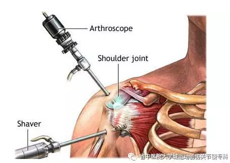 肩关节反复脱位怎么办? - 好大夫在线