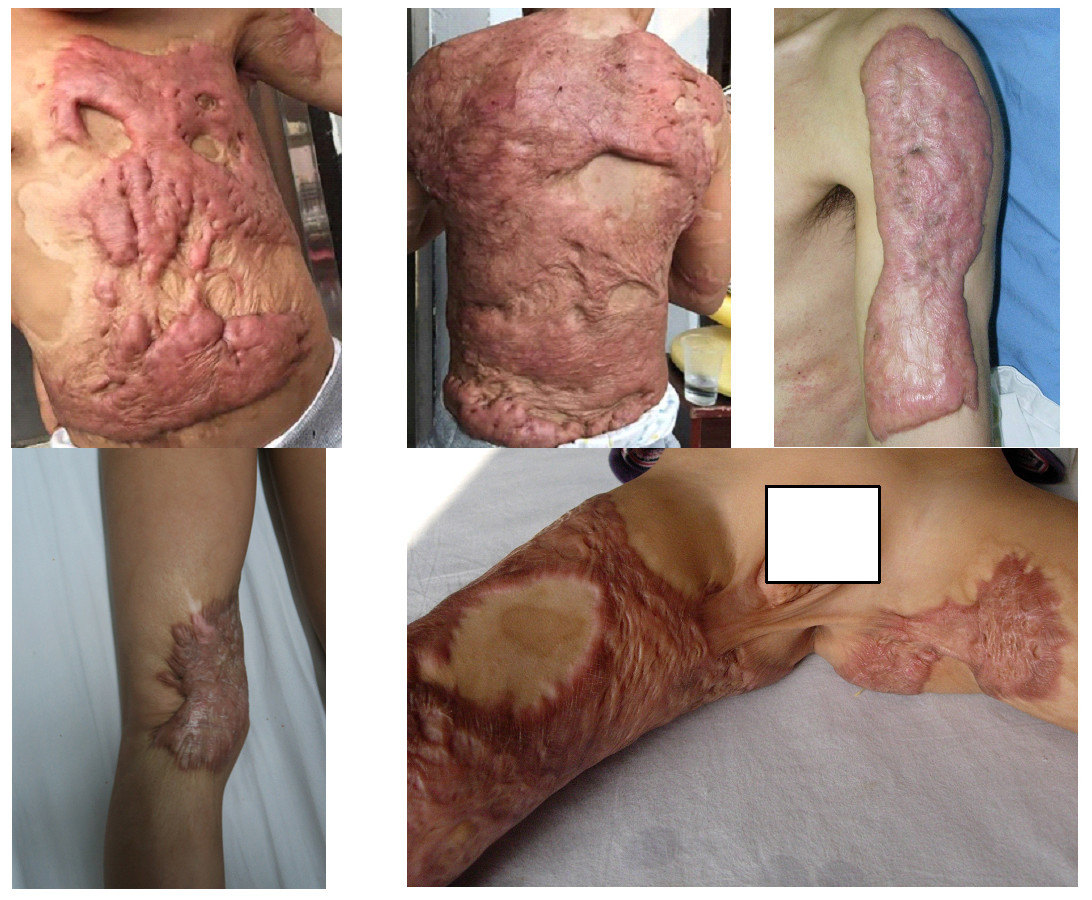 儿童疤痕治疗新选择---人工真皮pelnac联合头皮移植