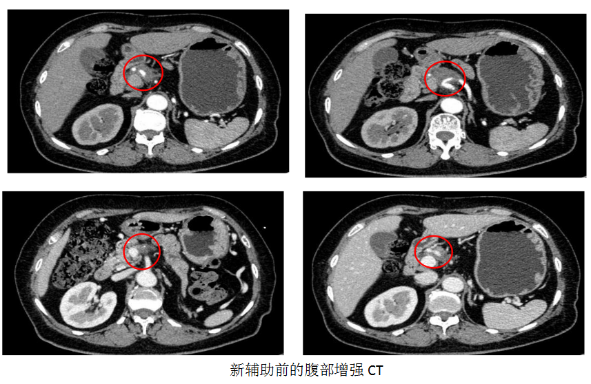 仁济医院胆胰外科运用新辅助治疗治疗胰腺癌的经验及总结