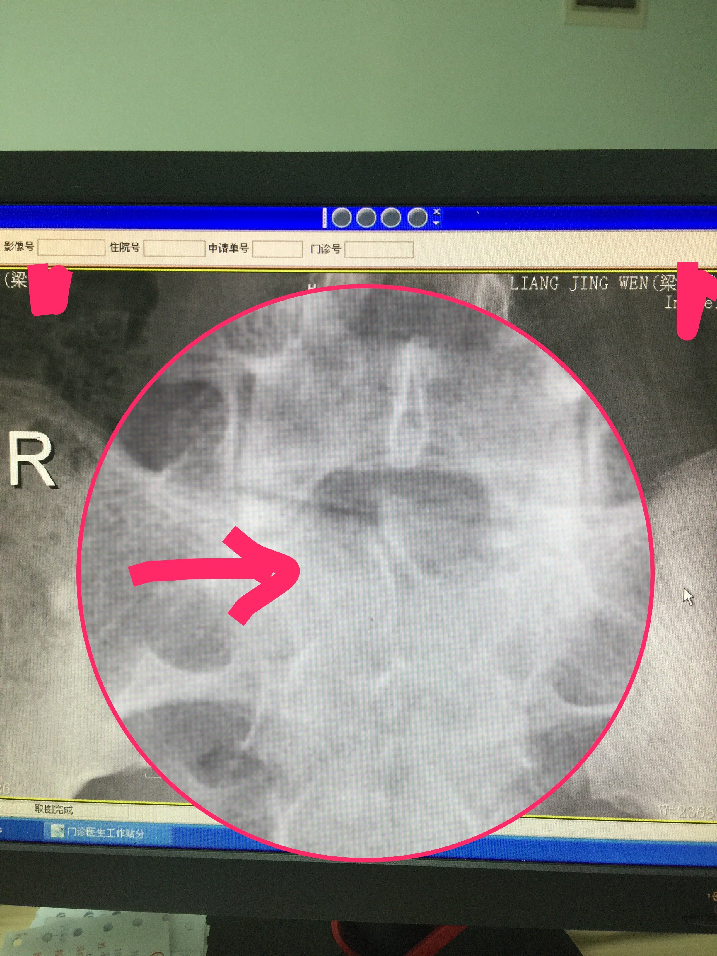 箭头指向的是骶骨隐裂,正常的应该有棘突果然,l5/s1椎间盘突出通过