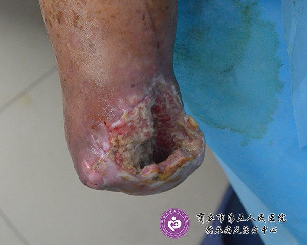 康复案例:糖尿病人上肢外伤截肢感染不愈合一