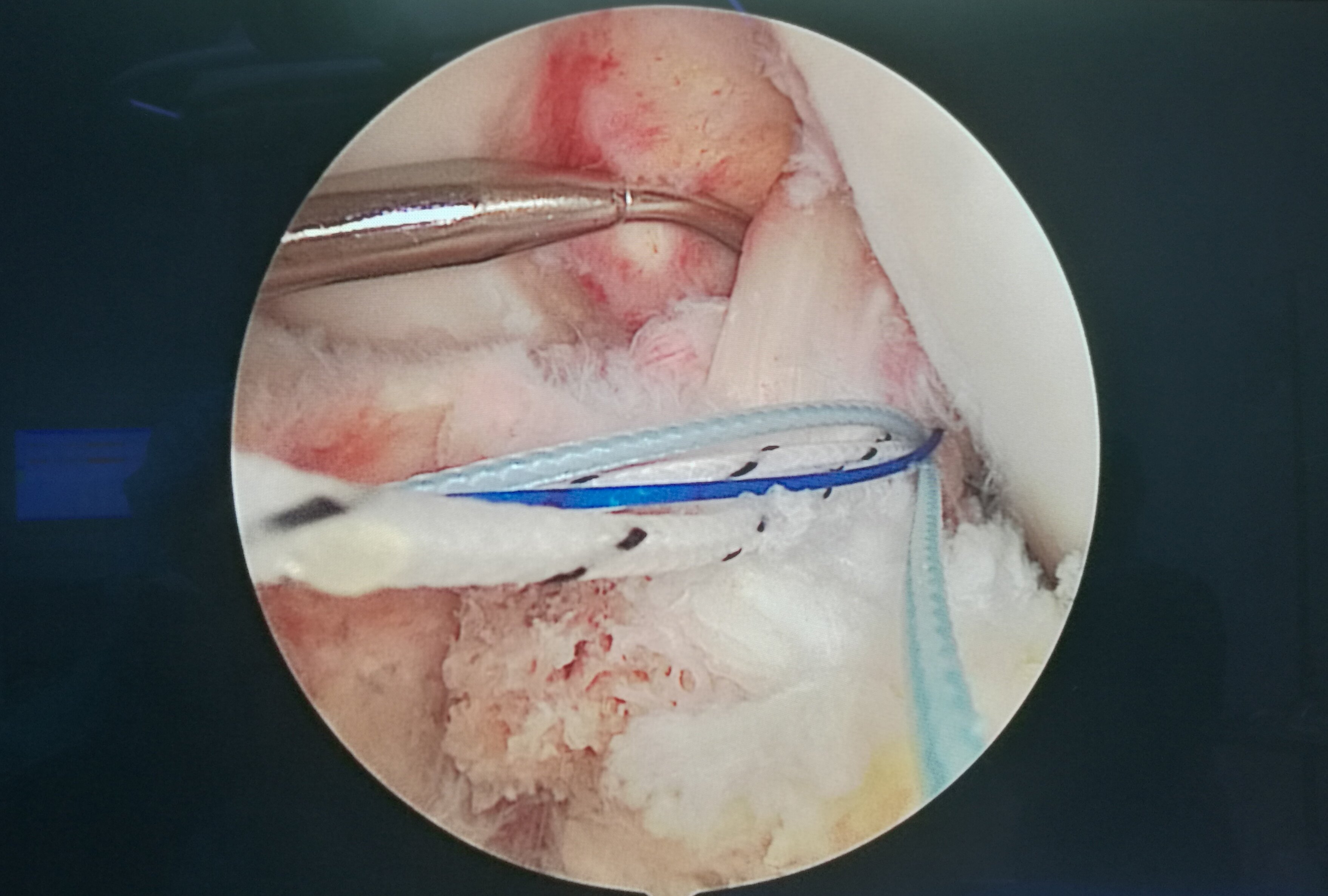 前交叉(十字)韧带撕脱骨折(髁间嵴)精彩手术 - 好大夫在线