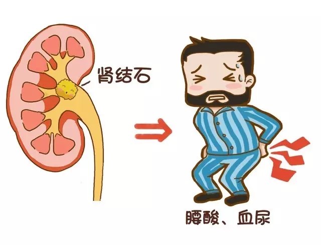 肾结石是怎么样形成的怎么样预防 vIYBAFniGLOAA0-hAACvUxT9Bl0505.jpg?_ms_=5a7a