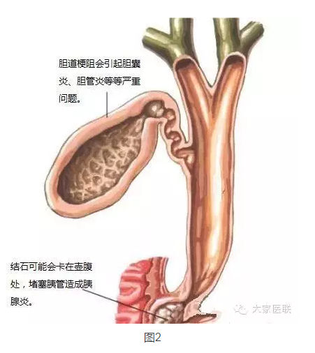 膽囊結石的前世今生