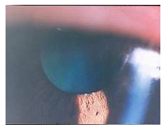 金银眼;国人:很难发现虹膜异色虹膜异色:-虹膜萎缩:虫蚀样外观-虹膜脱