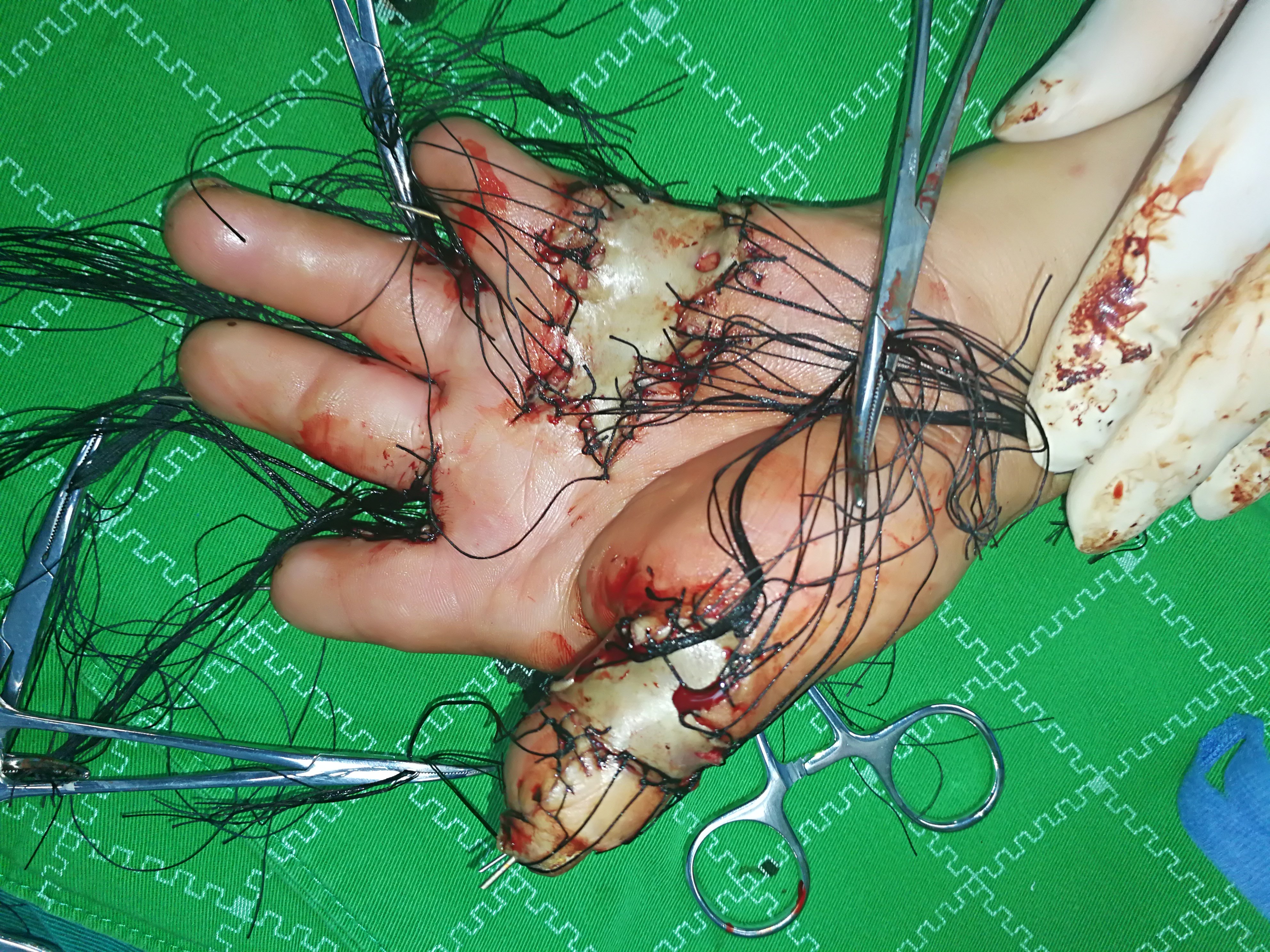 一个烧伤疤痕挛缩病例 - 好大夫在线