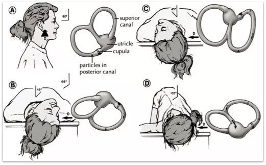 耳石症復位手法
