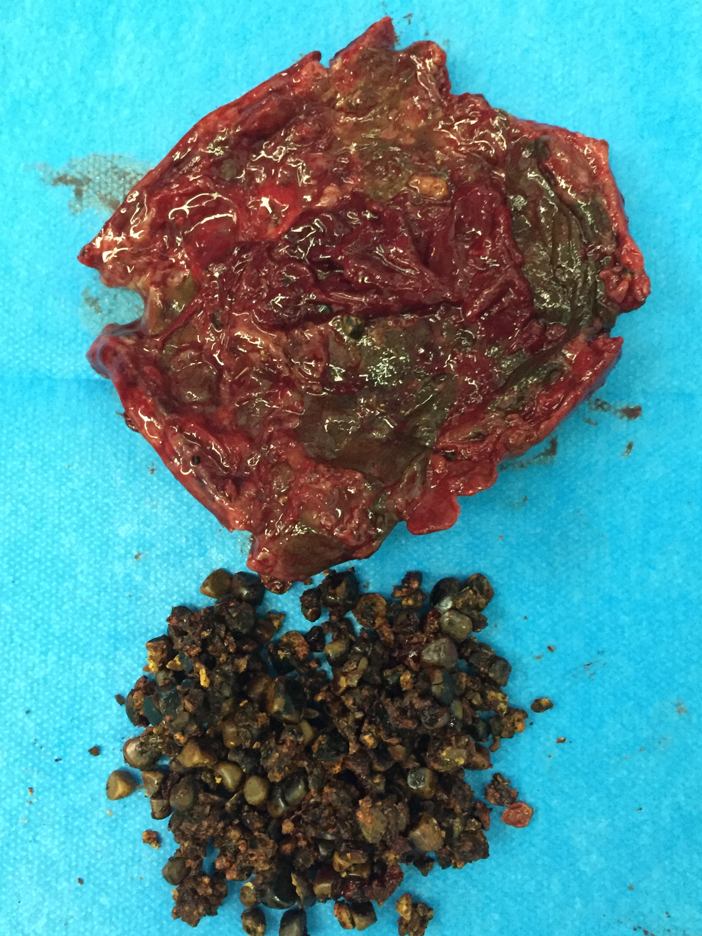 胆囊坏疽,充满结石,wei - 好大夫在线