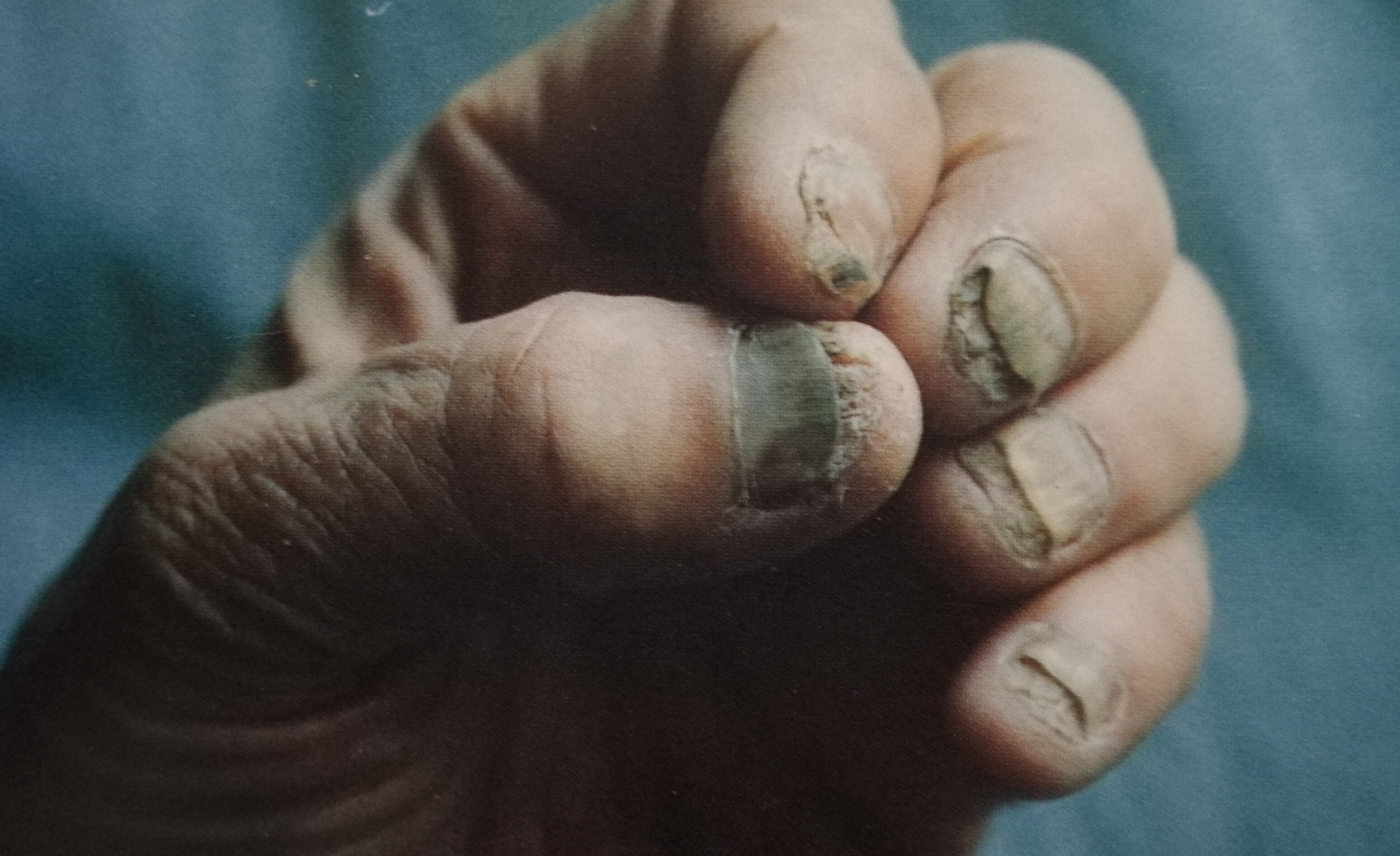 手指甲被真菌腐蚀图片图片