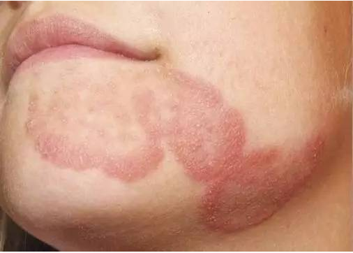 刺激性皮炎面部接触过敏性皮炎白色糠疹面部湿疹一些常见的"面部皮炎"