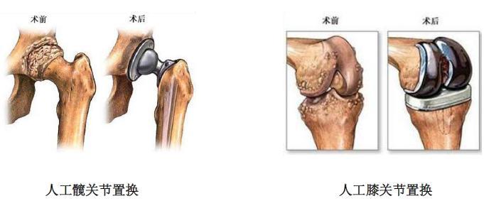 人工关节置换手术常见疑问解答 人工关节置换术 手术