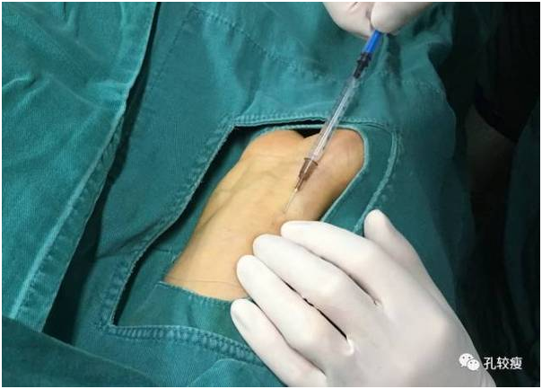 冠脉造影 - 好大夫在线