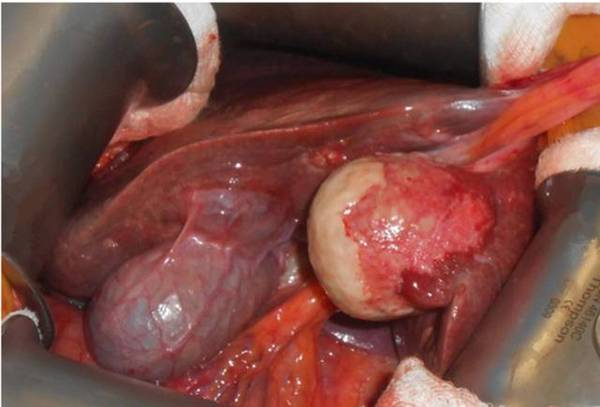 图解7种常见肝脏肿瘤—良性篇 - 好大夫在线