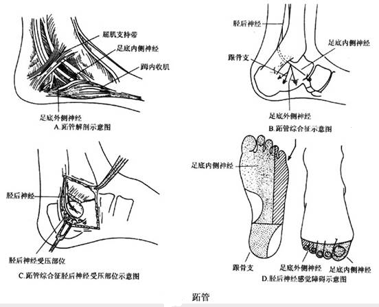 是指胫后神经在距小腿关节内侧的踝管内受压而产生的以足底内侧麻木