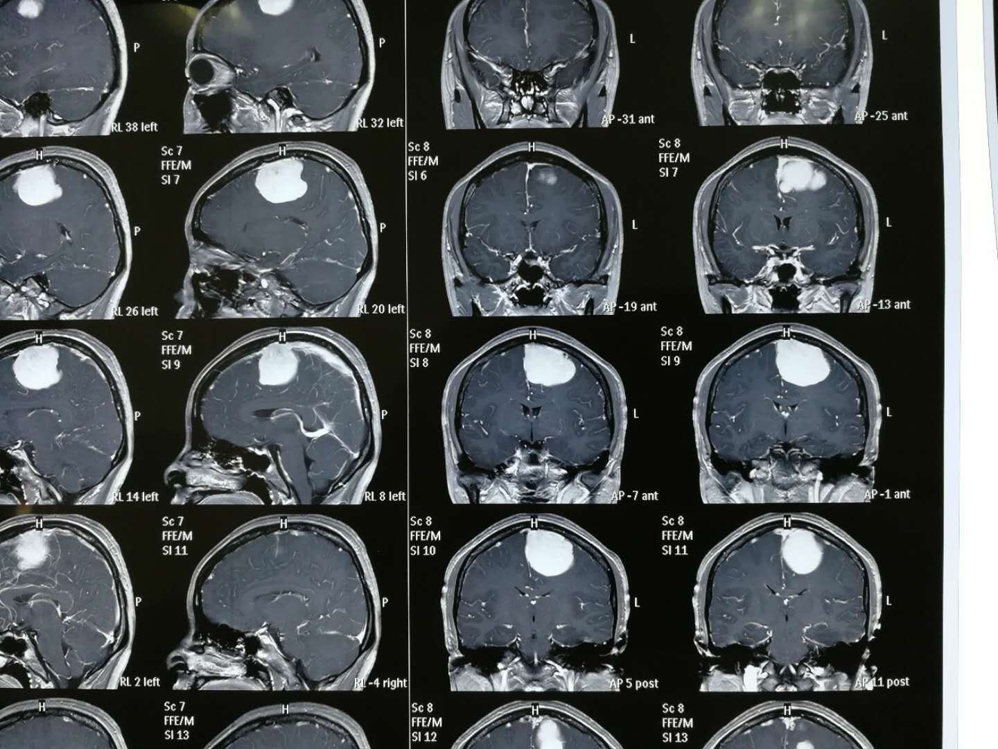 实例展示:左顶窦镰旁脑膜瘤术后半年复查 