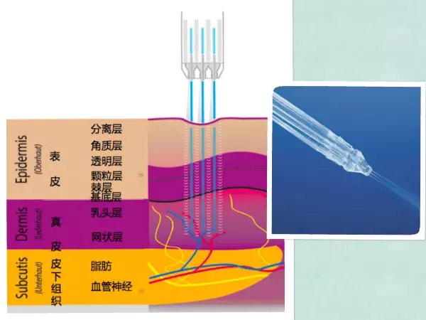 就是无针水光～无针水光通过高压射流原理,凭借高速气流推动营养成分