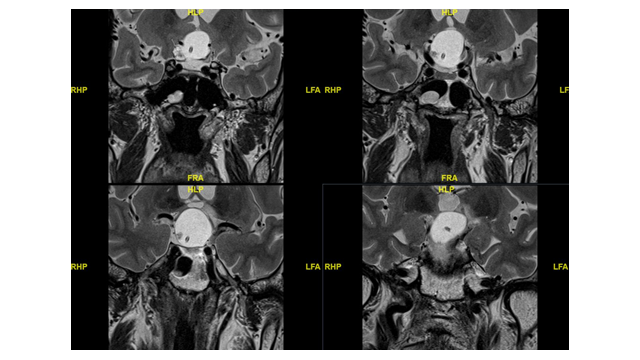科普幻灯片——ommaya储液囊在神经系统疾病中的应用 - 好大夫在线