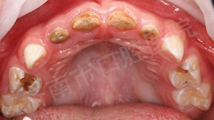 2,残障儿童龋,不能配合治疗者.