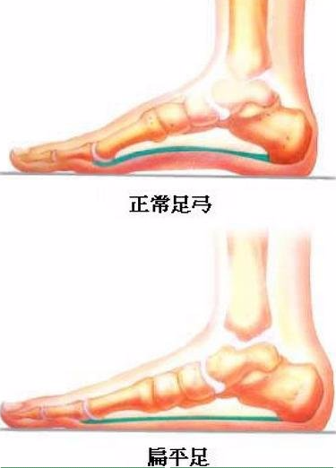 平足症起病隐袭,早期出现踝中部和中足于负重后疼痛和肿胀,可