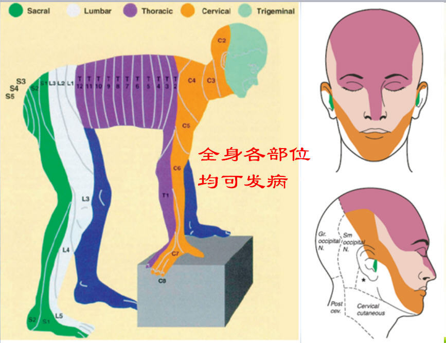 特徵:單側性,按神經節段分佈,集簇性皰疹.