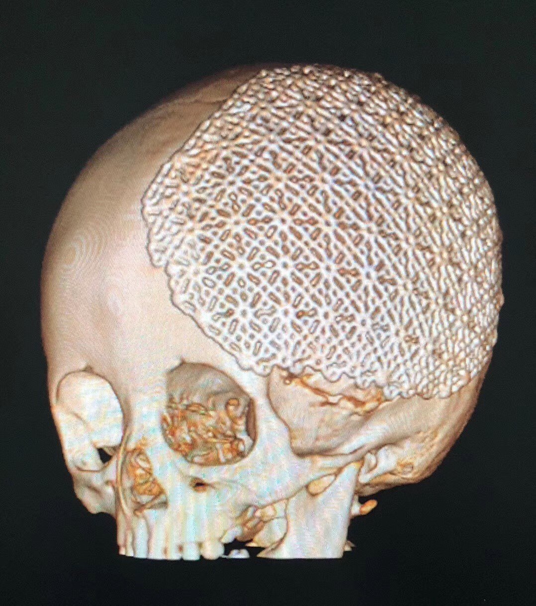 兒童顱骨缺損的手術治療顱骨修補術