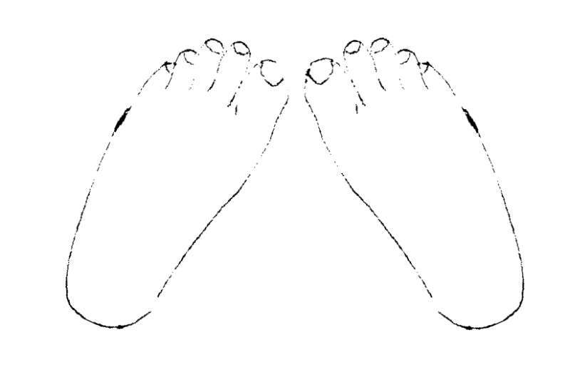 聊聊儿童 内八字 先天性足畸形 先天性足畸形疾病介绍