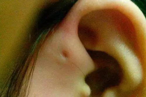 【耳前瘘管】有耳仓者有福气,这句话你懂多少?