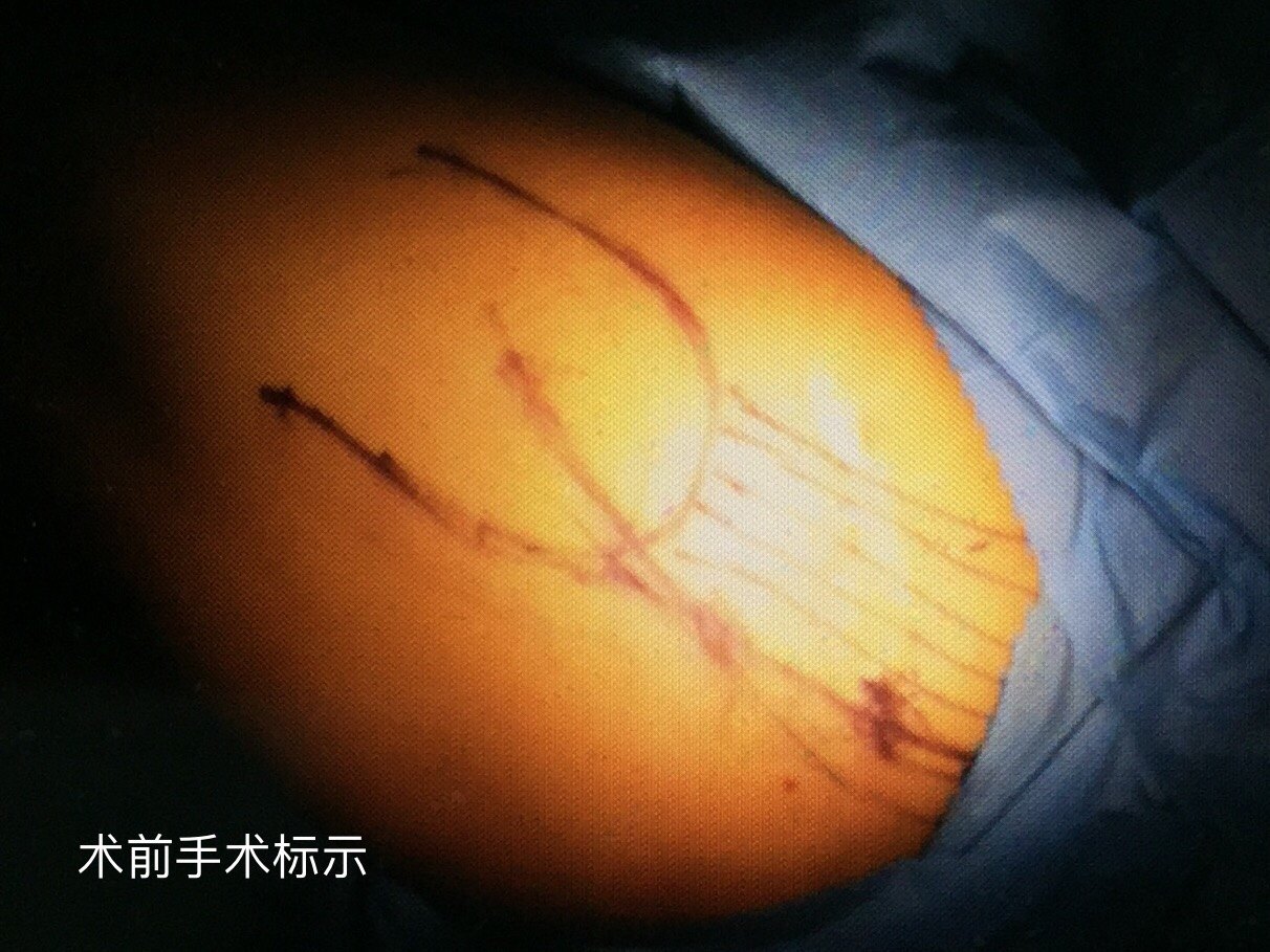 臀肌萎缩手术图片