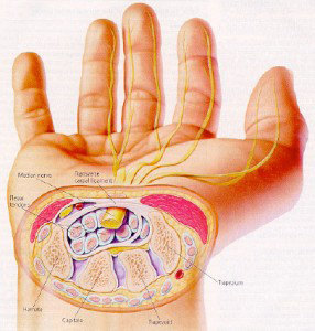 手指麻木的原因之一——腕管综合征