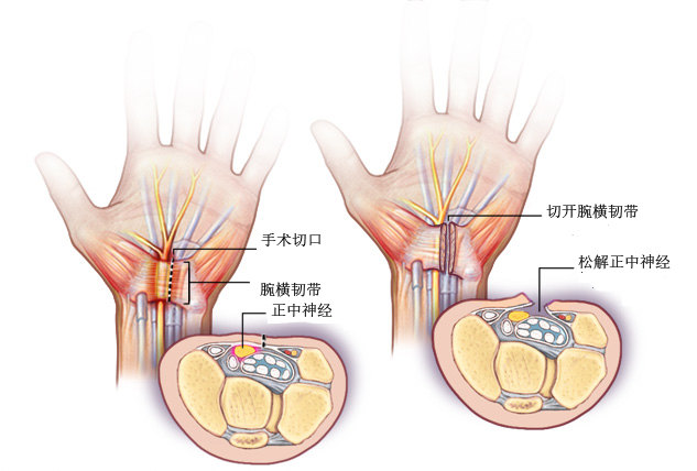 手指残端手术示意图图片