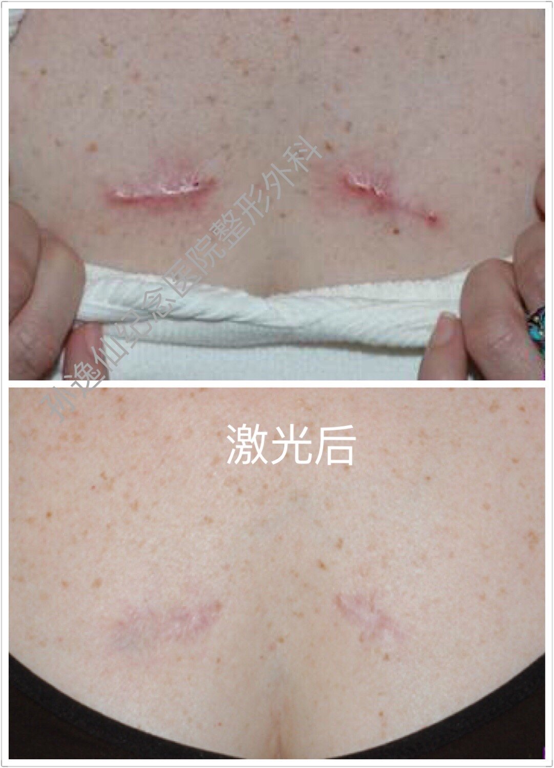 点阵激光治疗疤痕