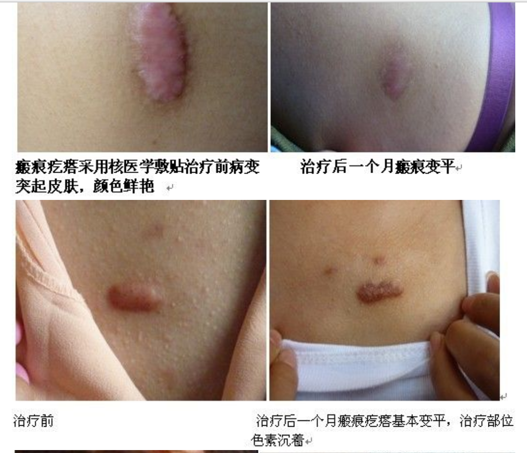 疤痕疙瘩最有效的治疗方法-----同位素敷贴(山东青岛) - 好大夫在线