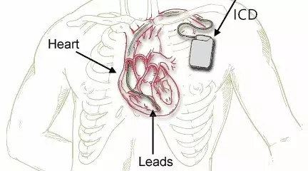 医生说,我需要装"心脏除颤起搏器" - 好大夫在线