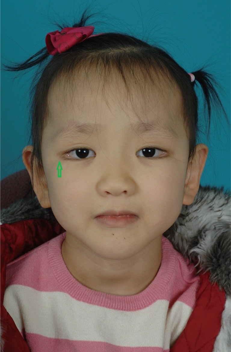 kabuki综合征歌舞伎脸谱综合征