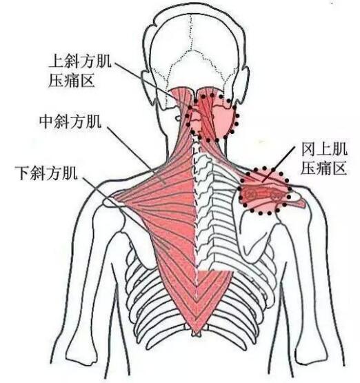 肩肌劳损疼痛位置图图片