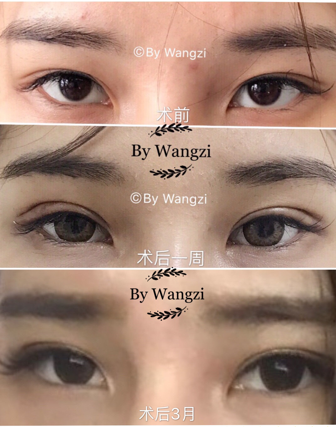 双眼皮,开眼角术前术后对比照片 - 好大夫在线