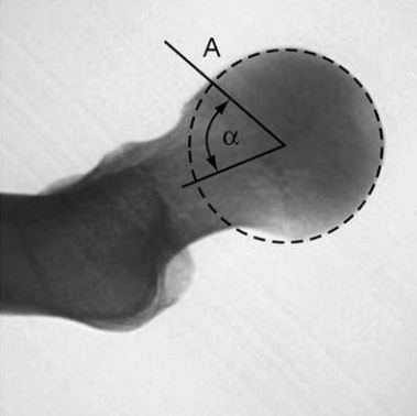 股骨髋臼撞击症fai髋关节疼痛患者为什么要拍dunn位片