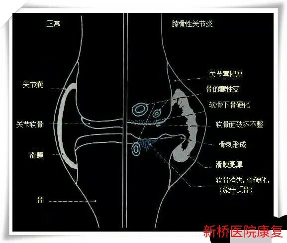 膝关节创伤性滑膜炎 - 好大夫在线