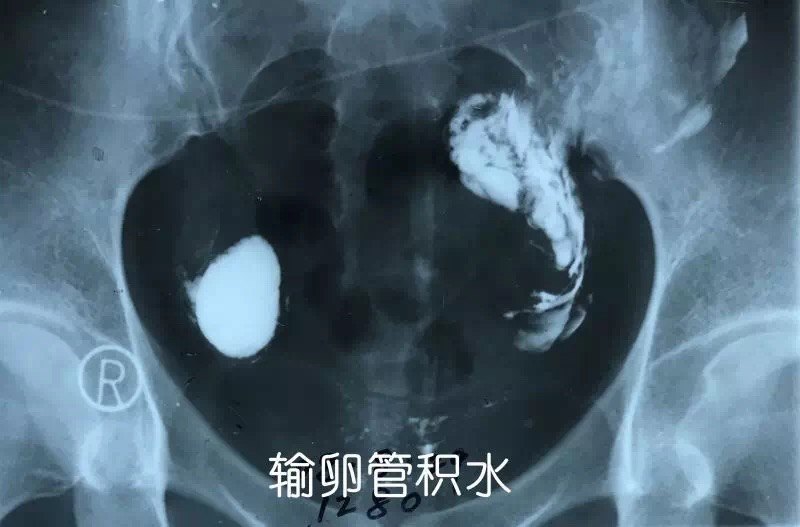 子宫输卵管造影,您真的了解吗?